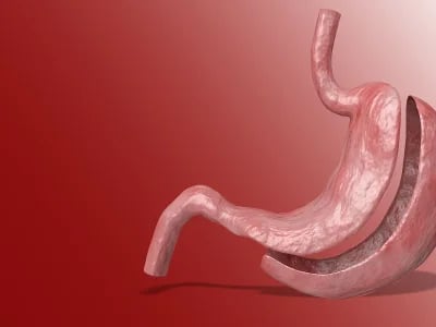 Die beste Option für Ihre Gesundheit: Magenverkleinerung Türkei